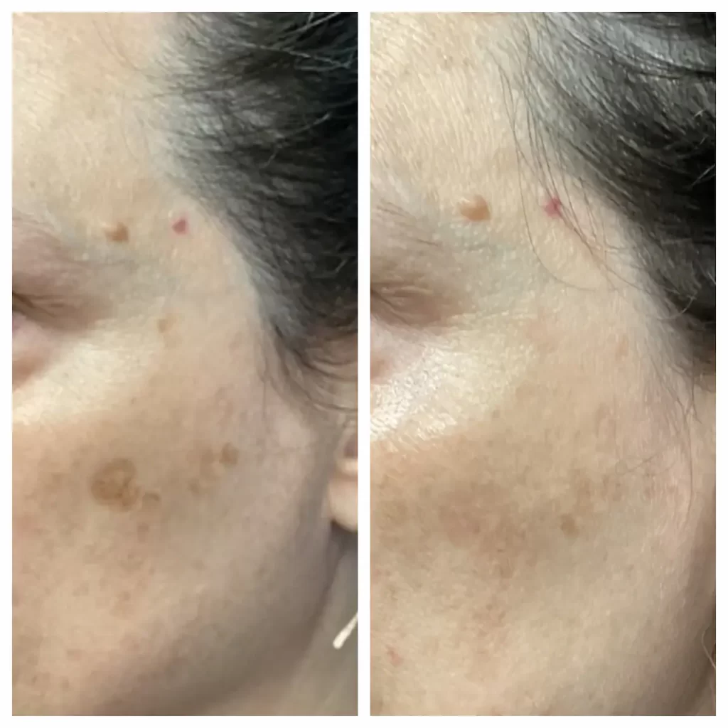 Brown spots before and after treatment, patient of Dr. Brandon T. Beal
