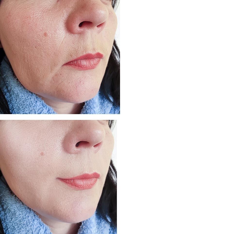 Cheeks before and after cheek filler treatment, patient of Dr. Brandon T. Beal in Jacksonville, FL