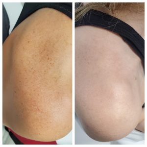 Sun spots on the shoulder before and after a TCA chemical peel, patient of Dr. Brandon T. Beal