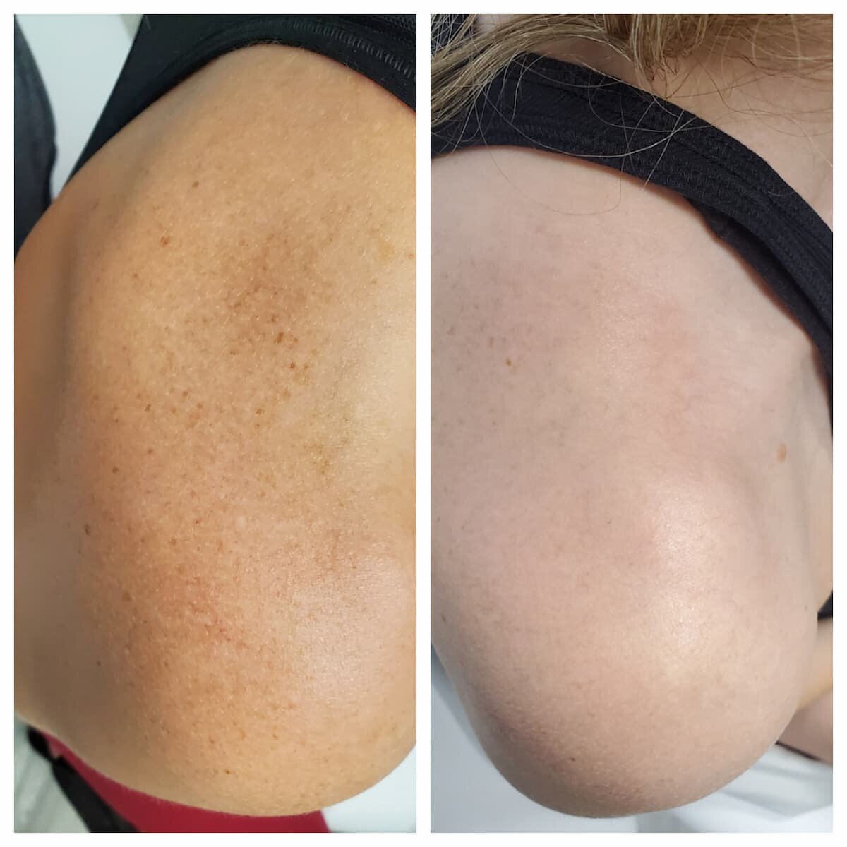 Sun spots on the shoulder before and after a TCA chemical peel, patient of Dr. Brandon T. Beal
