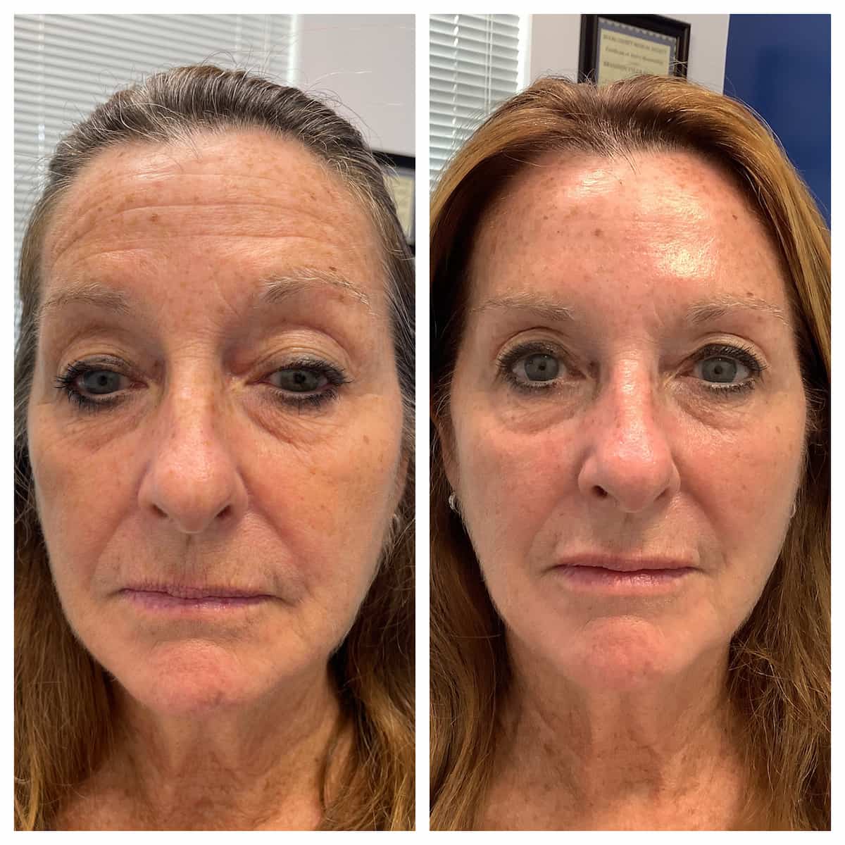 Face before and after facial rejuvenation, front view, patient of Dr. Brandon T. Beal in Jacksonville, FL