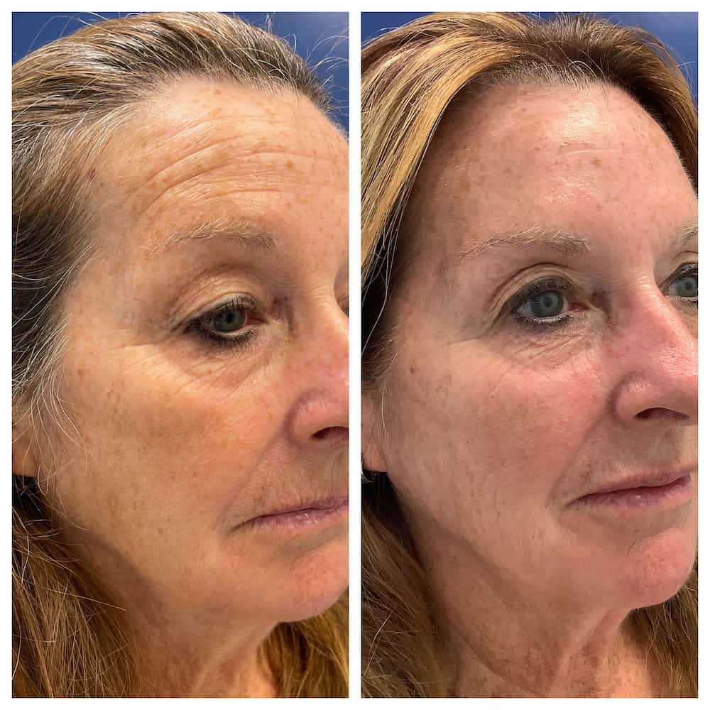 Face before and after facial rejuvenation, side view, patient of Dr. Brandon T. Beal in Jacksonville, FL
