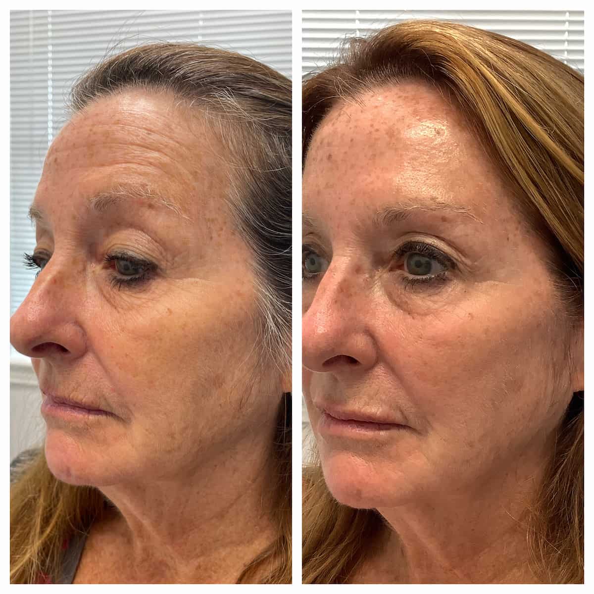 Face before and after facial rejuvenation, three-quarter view, patient of Dr. Brandon T. Beal in Jacksonville, FL