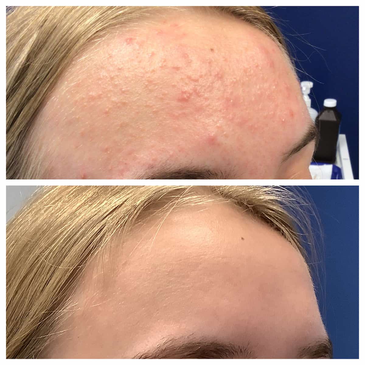 Forehead acne before and after treatment results, patient of Dr. Brandon T. Beal