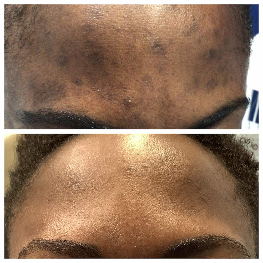 Facial hyperpigmentation before and after treatment, patient of Dr. Brandon T. Beal