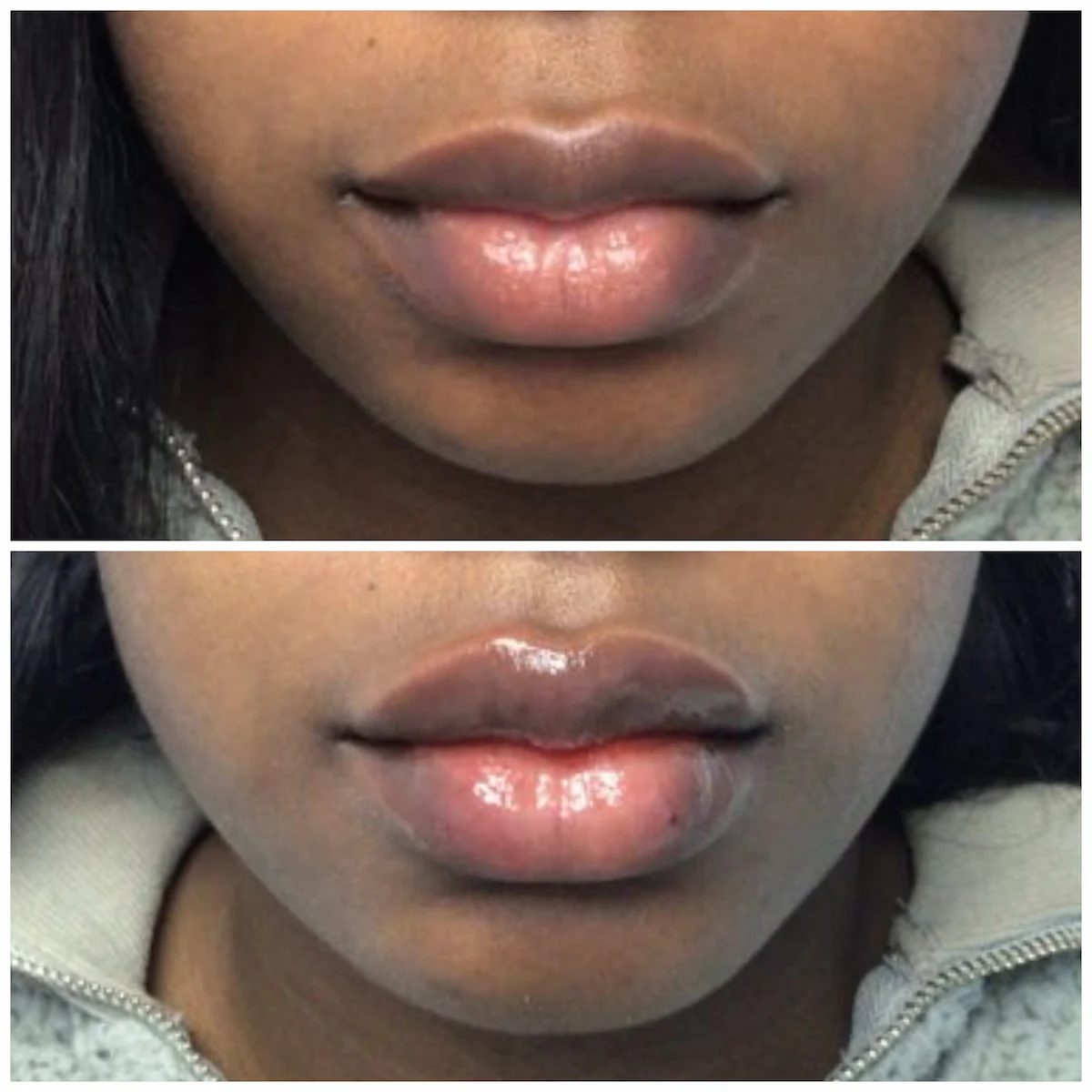Lips before and after lip filler treatment, patient of Dr. Brandon T. Beal