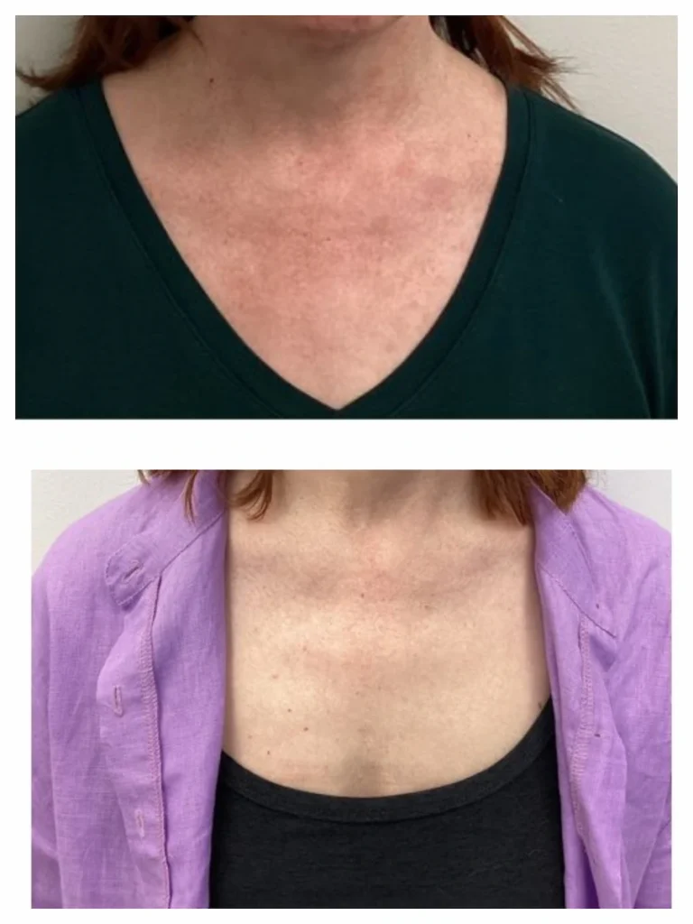 Sun damage on the chest before and after M22 IPL treatment, patient of Dr. Brandon T. Beal