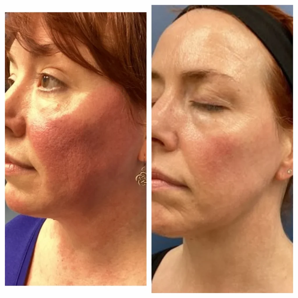 Facial redness before and after M22 IPL treatment, frontal view, patient of Dr. Brandon T. Beal