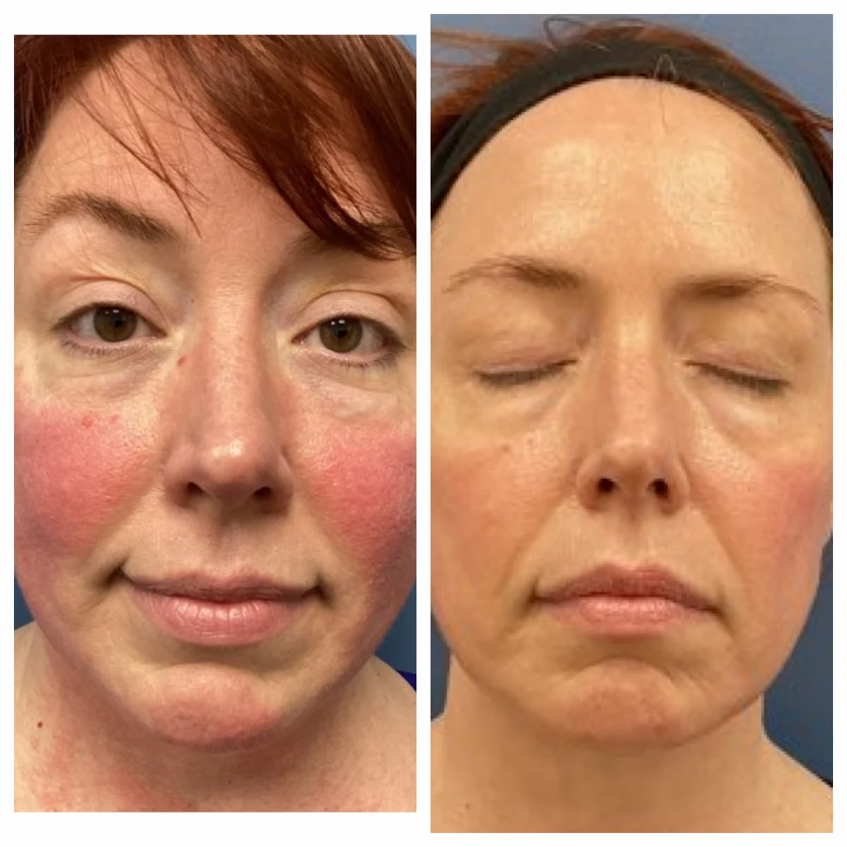 M22 IPL before and after for cheek redness in Jacksonville, angled view, patient of Dr. Brandon T. Beal