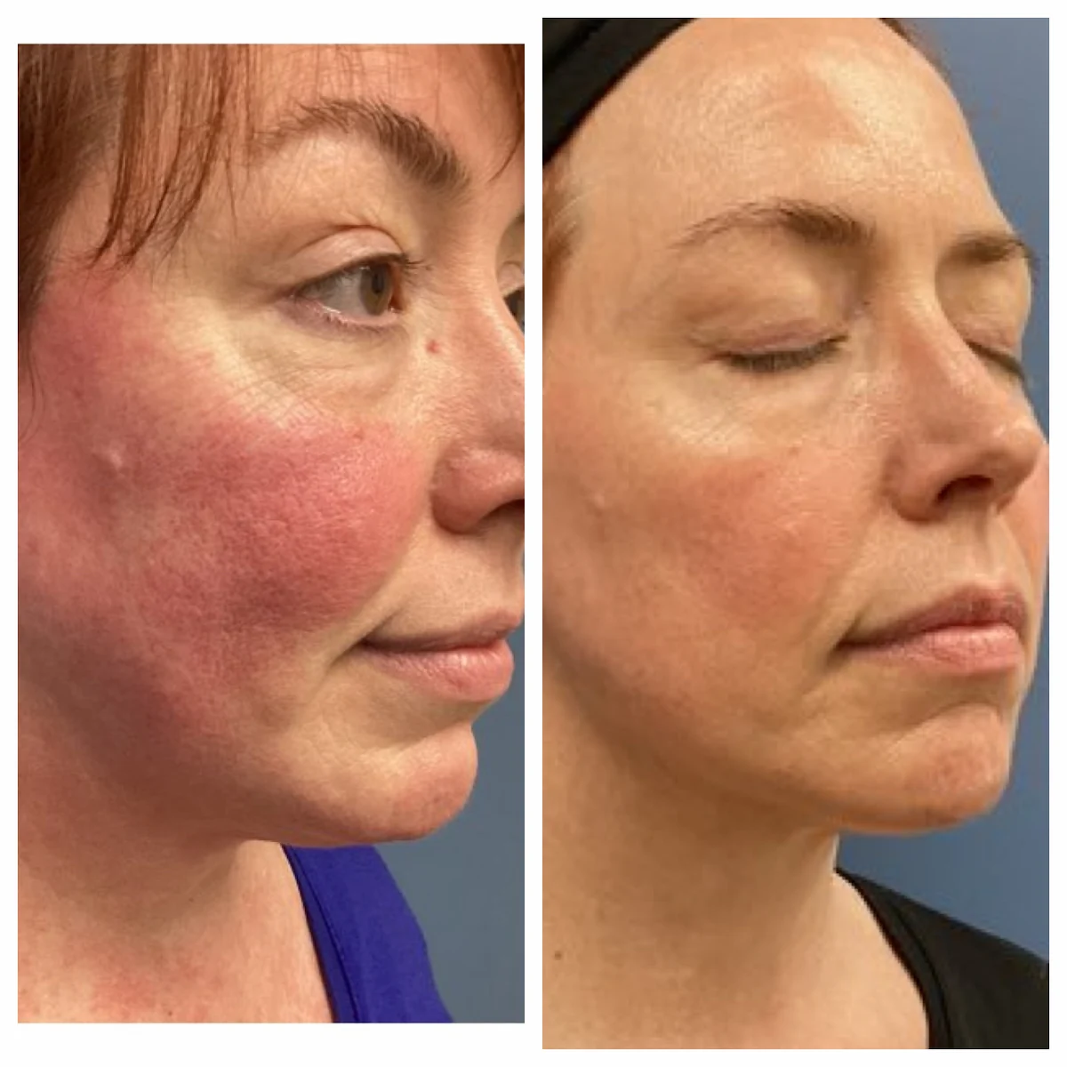 M22 IPL before and after for facial redness in Jacksonville, profile view, patient of Dr. Brandon T. Beal
