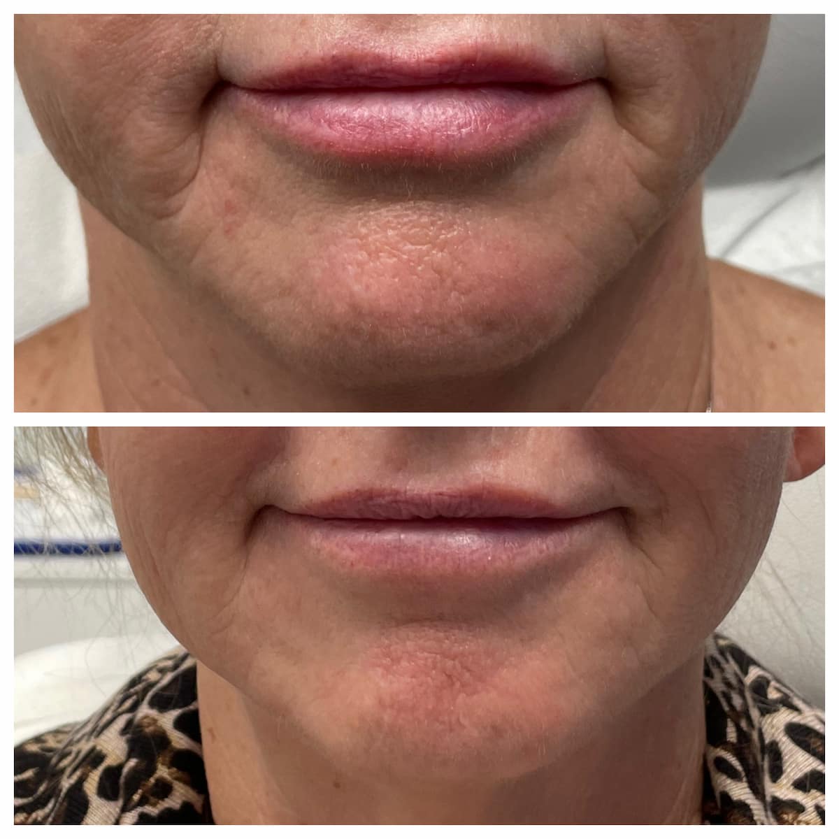Marionette lines before and after dermal filler, patient of Dr. Brandon T. Beal