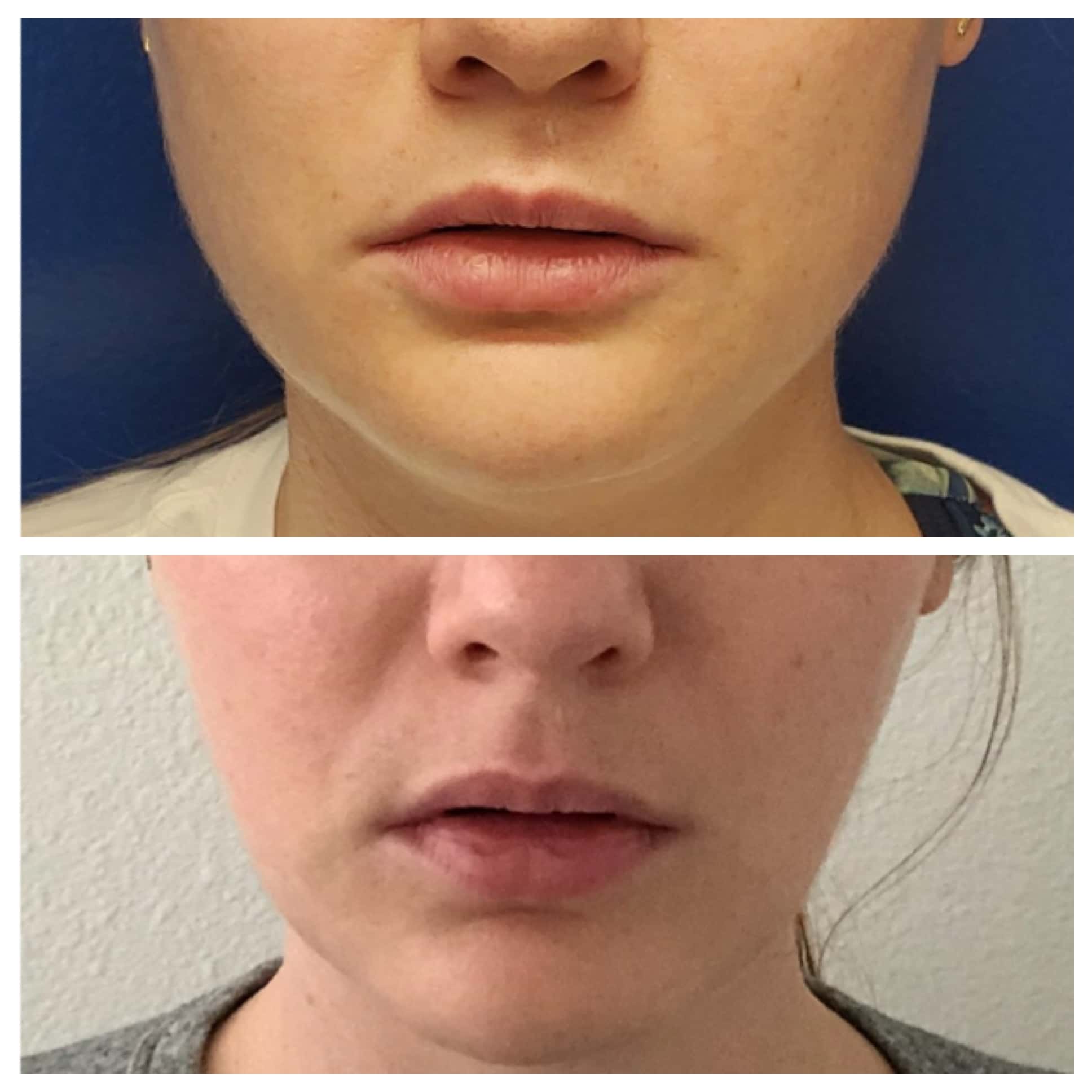 Masseter Botox for jaw slimming before and after, patient of Dr. Brandon T. Beal