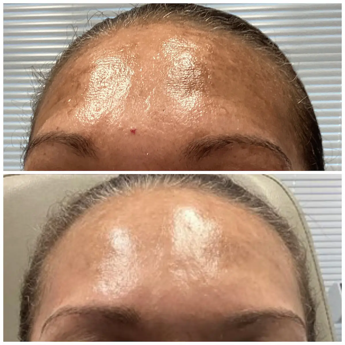 Melasma on the forehead before and after treatment, patient of Dr. Brandon T. Beal