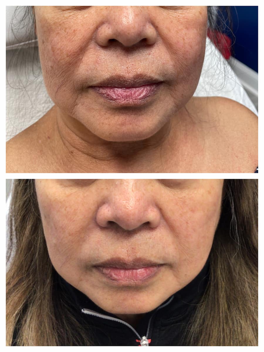 Nasolabial folds (smile lines) before and after dermal filler, patient of Dr. Brandon T. Beal