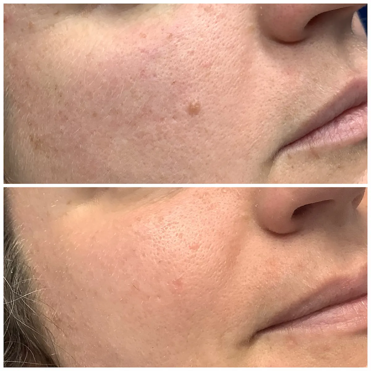 Cheek mole before and after non-surgical removal, patient of Dr. Brandon T. Beal