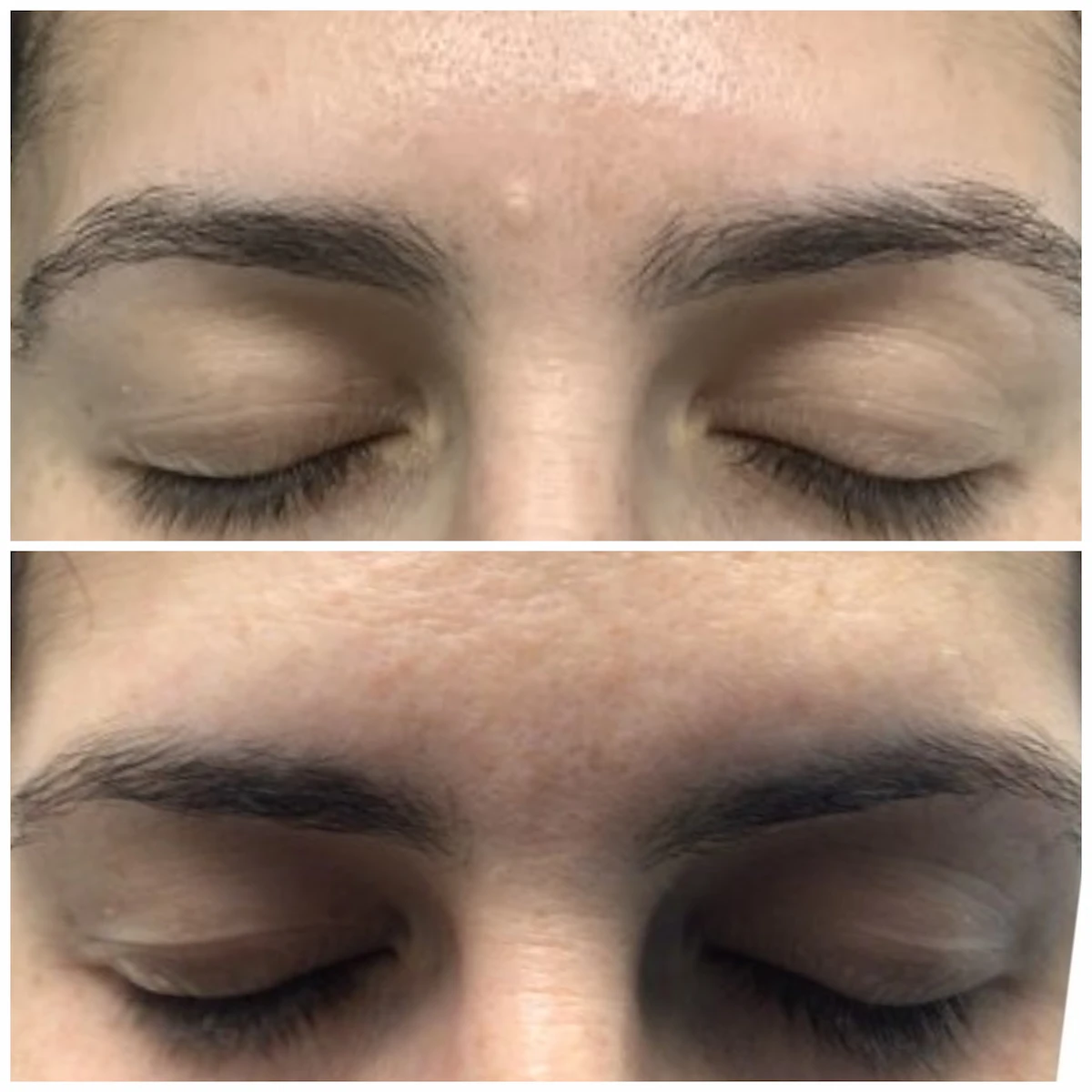 Mole between the brows before and after non-surgical removal, patient of Dr. Brandon T. Beal