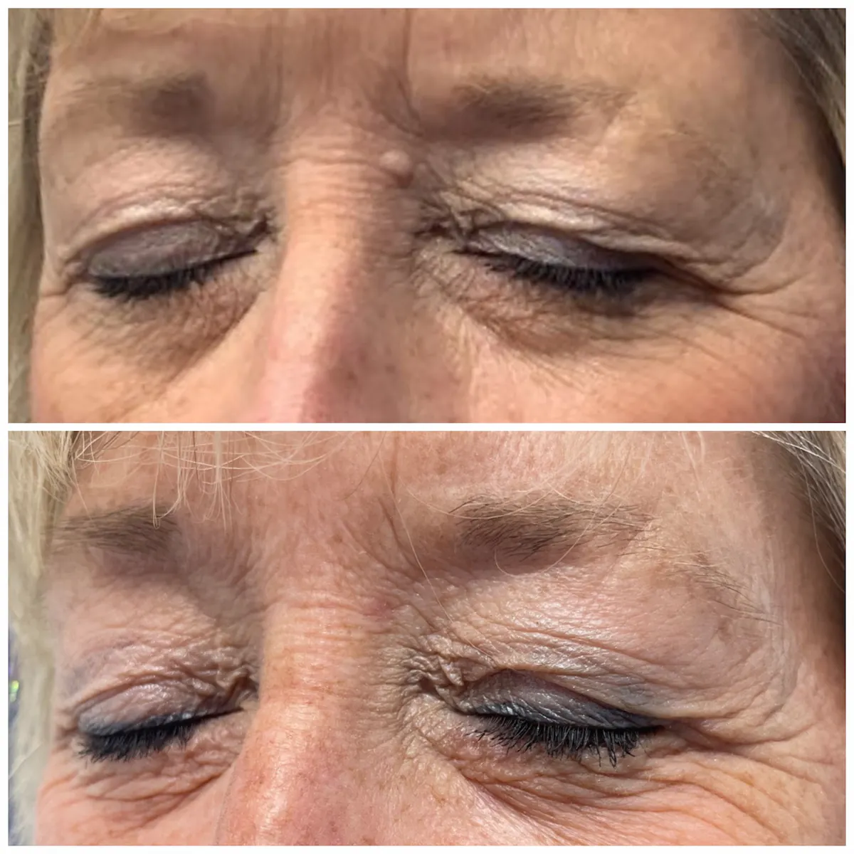 Eyelid-area mole before and after non-surgical removal, patient of Dr. Brandon T. Beal
