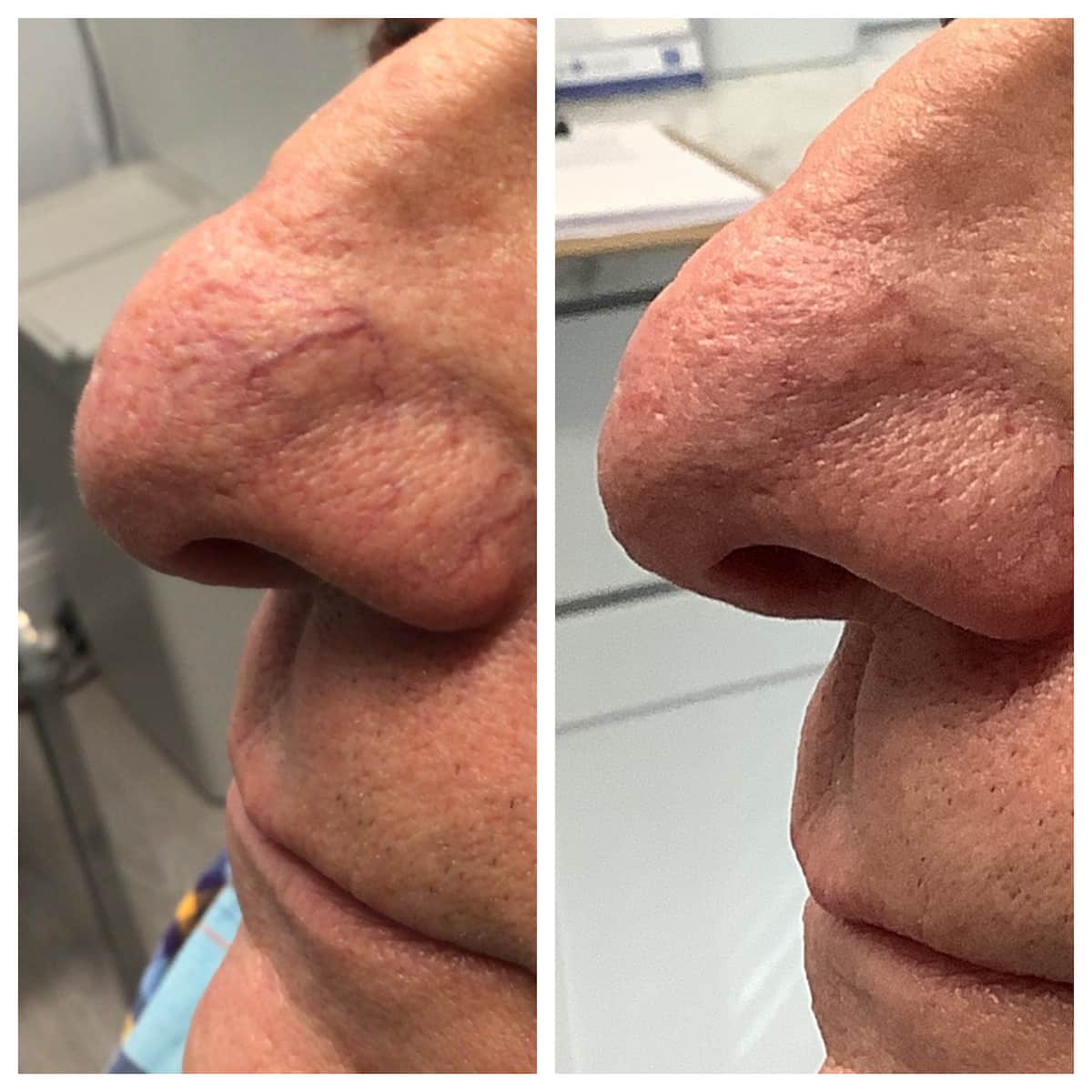 Visible blood vessels on the nose before and after treatment, patient of Dr. Brandon T. Beal
