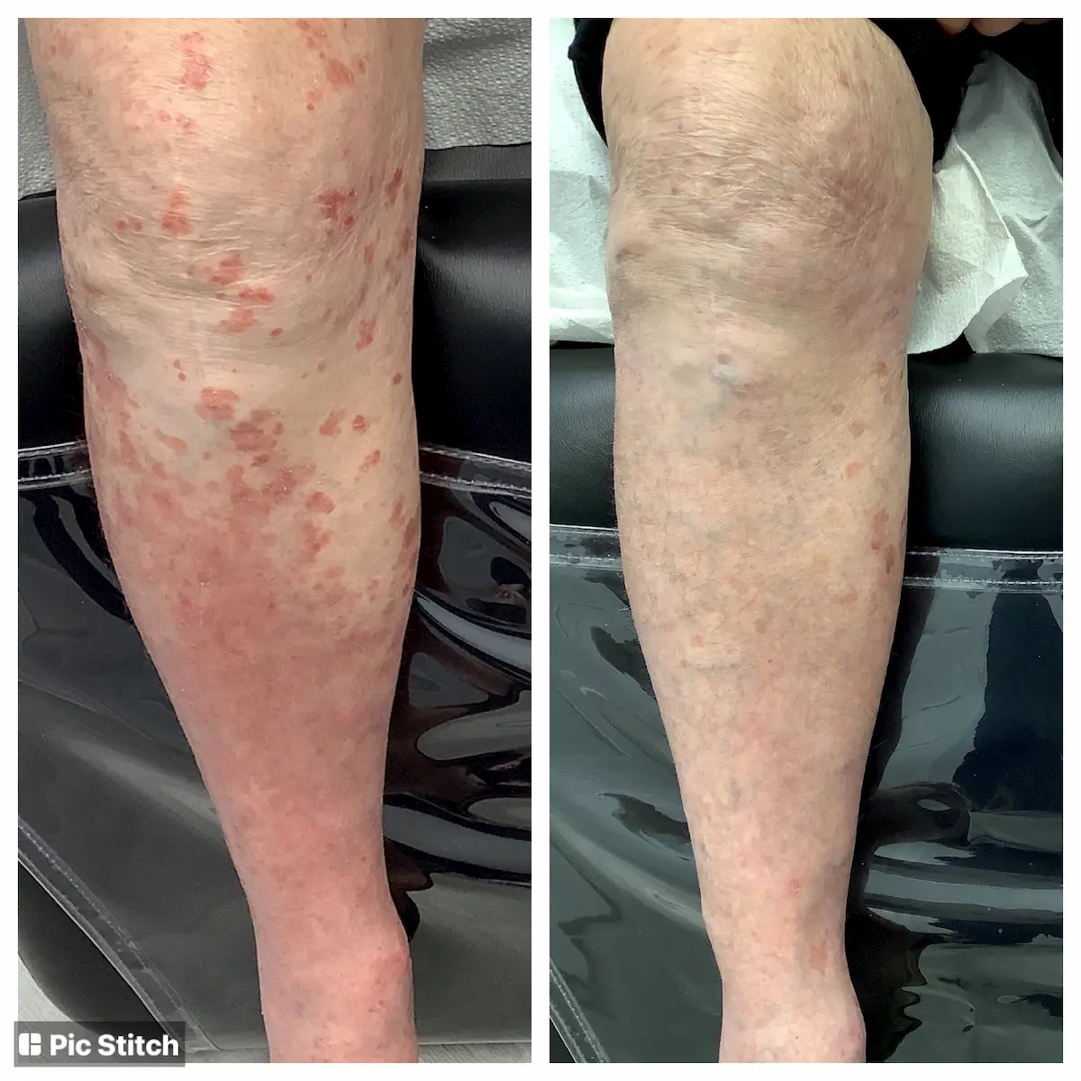 Psoriasis plaques before and after treatment, patient of Dr. Brandon T. Beal