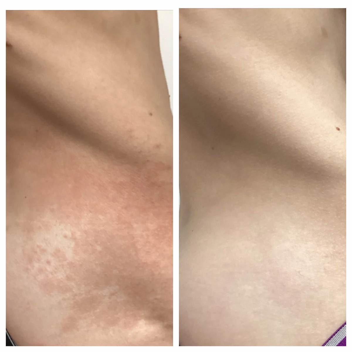 Inflamed rash before and after treatment, patient of Dr. Brandon T. Beal