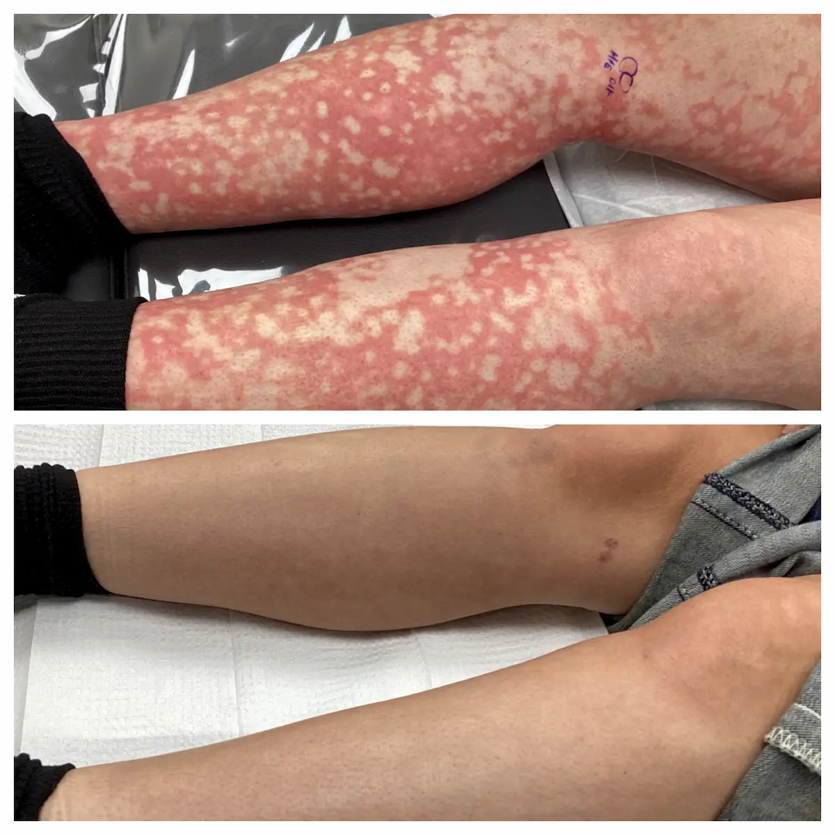 Leg rash before and after treatment, patient of Dr. Brandon T. Beal