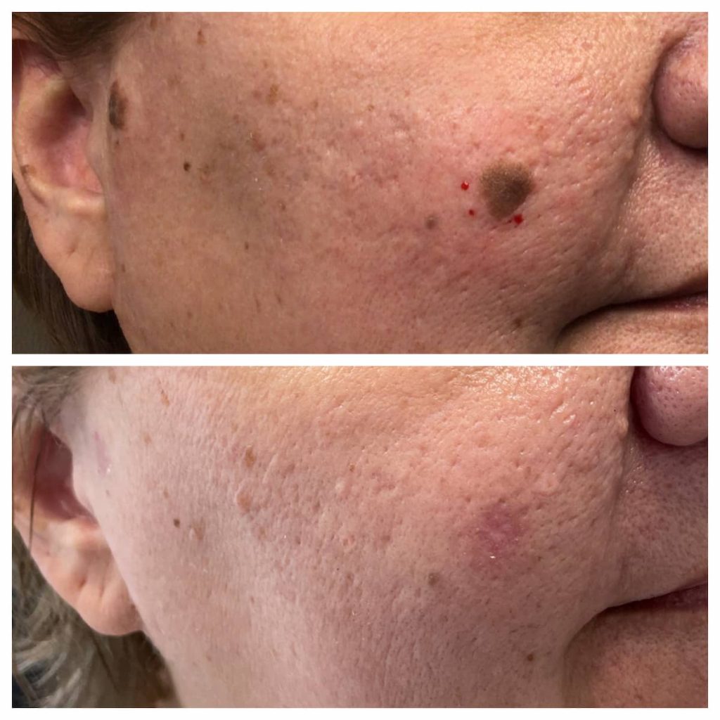 Seborrheic keratoses before and after removal, patient of Dr. Brandon T. Beal