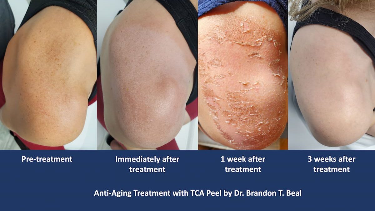 TCA chemical peel recovery timeline from pre-treatment through three weeks, patient of Dr. Brandon T. Beal